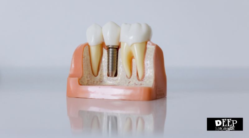 All-on-4 Dental Implants Explained: Fixed Teeth, Fewer Implants, Real Stability